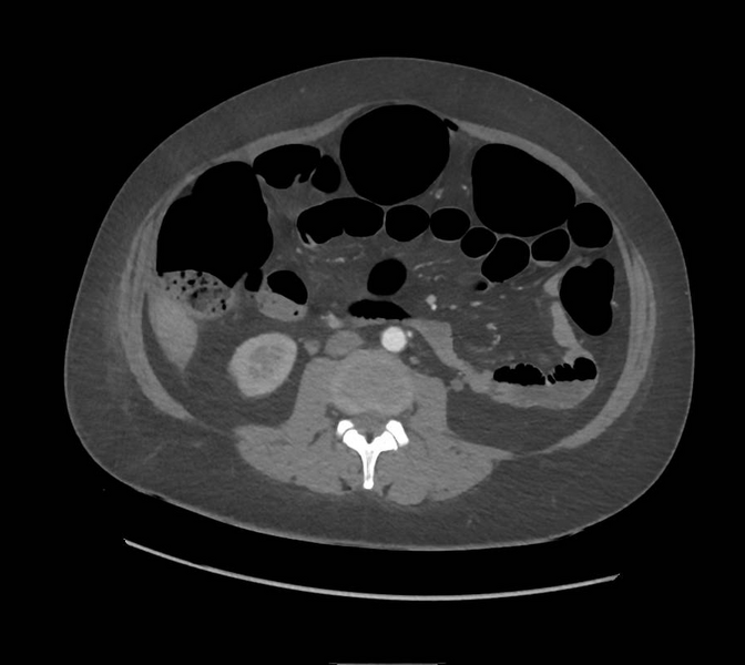 File:Colonic pseudo-obstruction (Radiopaedia 79752-92980 A 97).png