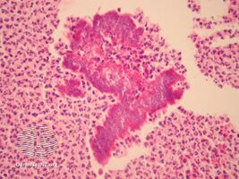pathology-Botryomycosis