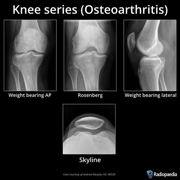 File:Knee series (osteoarthritis) (Radiopaedia 68583).jpeg