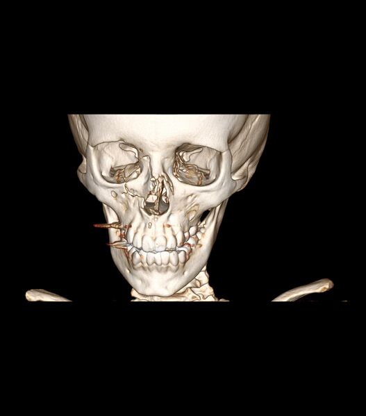 File:Nasoorbitoethmoid fracture (Radiopaedia 90044-107205 3D VRT 19).jpg