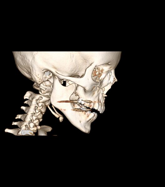File:Nasoorbitoethmoid fracture (Radiopaedia 90044-107205 3D VRT 3).jpg