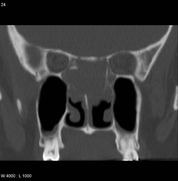 File:Nasopharyngeal carcinoma (recurrent) (Radiopaedia 5061-6903 Coronal bone window 5).jpg