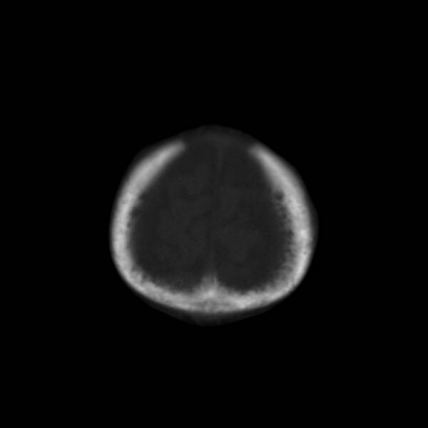 File:Neuroblastoma with skull metastases (Radiopaedia 30326-30958 Coronal bone window 6).jpg