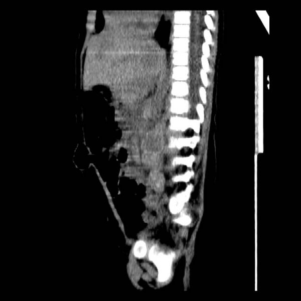 File:Neuroblastoma with skull metastases (Radiopaedia 30326-30960 B 25).jpg