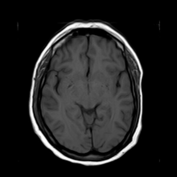 File:Neurofibromatosis type 2 (Radiopaedia 67470-76871 Axial T1 11).jpg