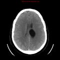 Neuroglial cyst (Radiopaedia 10713-11185 Axial non-contrast 13).jpg