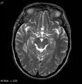 Neurosarcoidosis (Radiopaedia 10930-17204 Axial T2 8).jpg