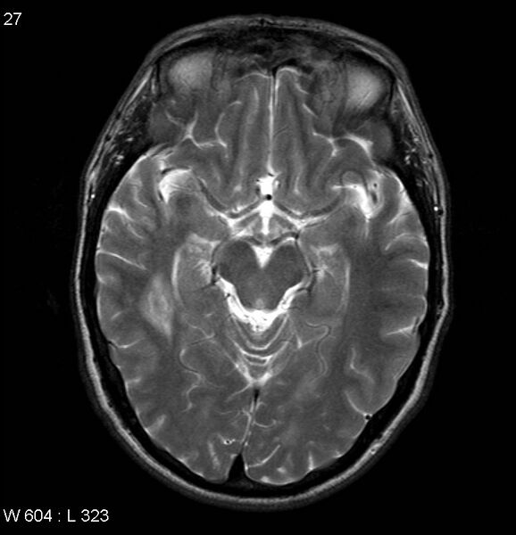 File:Neurosarcoidosis (Radiopaedia 10930-17204 Axial T2 8).jpg