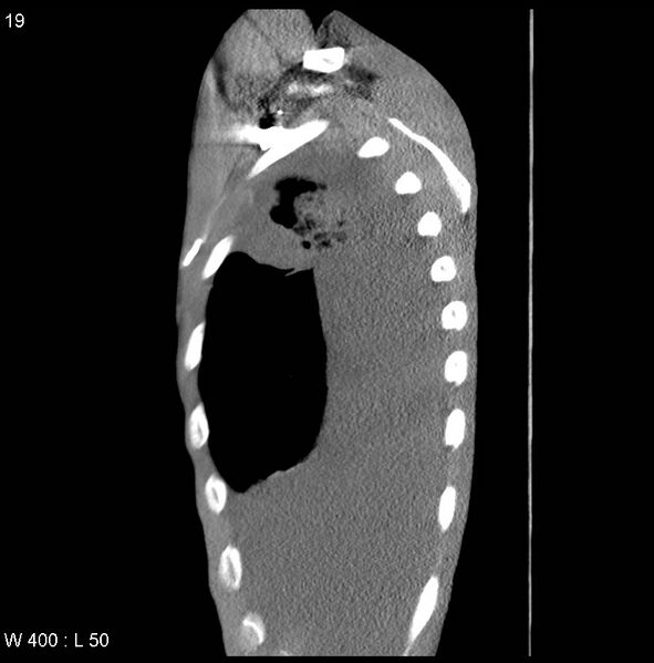 File:Non-Hodgkin lymphoma involving lung (Radiopaedia 29094-29470 D 10).jpg