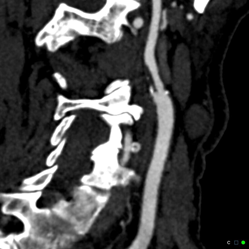Non-occlusive intraluminal internal carotid artery thrombus (Radiopaedia 37751-39658 C 9).jpg