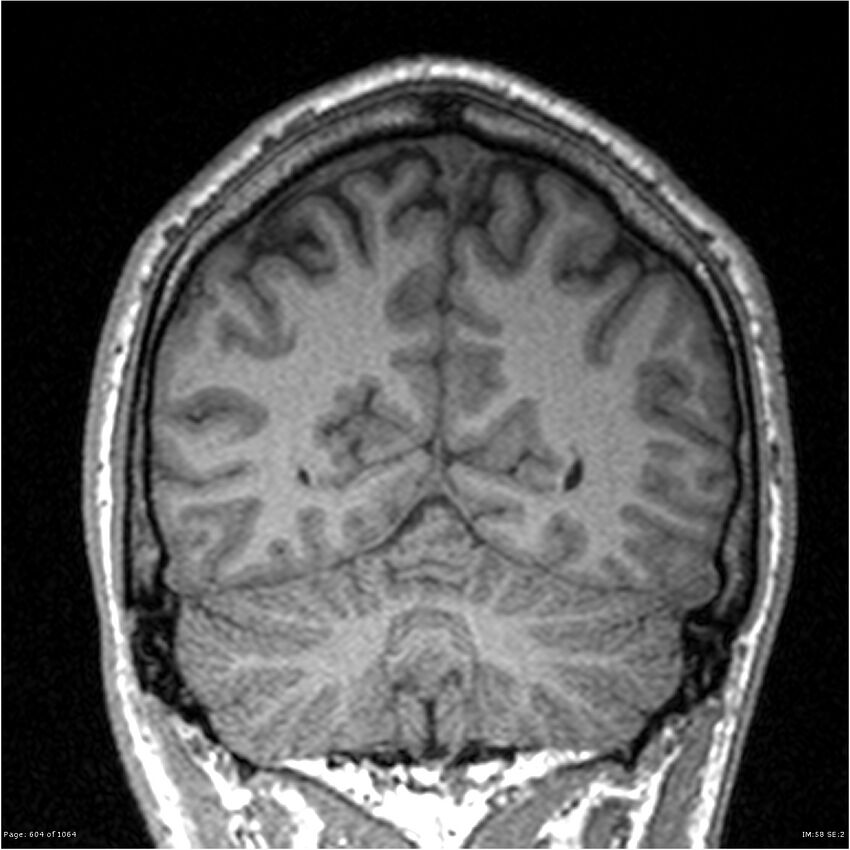 Normal brain MRI (non-focal epilepsy protocol) (Radiopaedia 38571-40700 Coronal T1 28).jpg