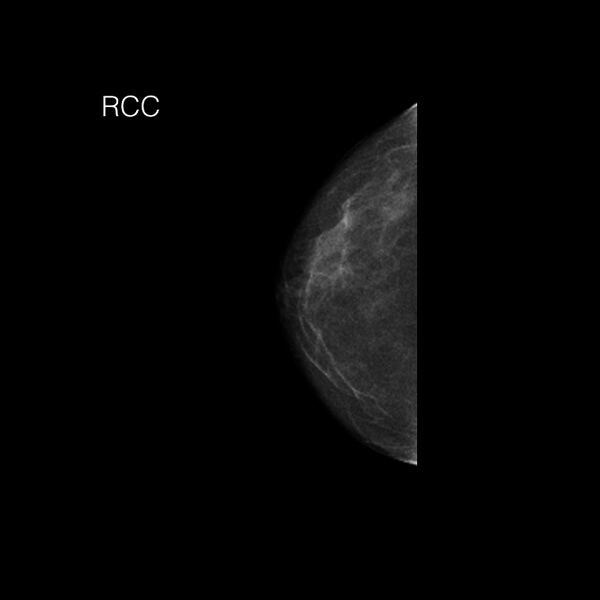 File:Normal breast mammography (tomosynthesis) and ultrasound (Radiopaedia 65325-74355 CC 1).jpeg