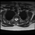 Normal cervical and thoracic spine MRI (Radiopaedia 35630-37156 Axial T2 2).png