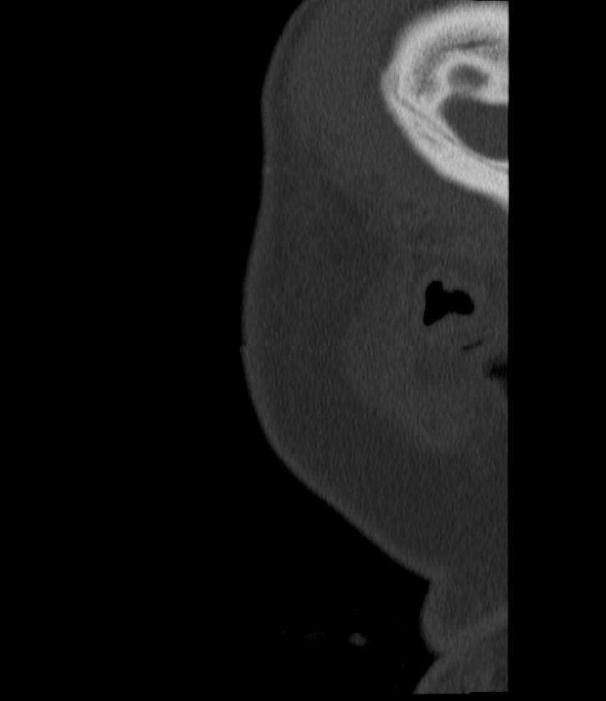Normal facial bone CT (Radiopaedia 88742-105476 Sagittal bone window 157).jpg