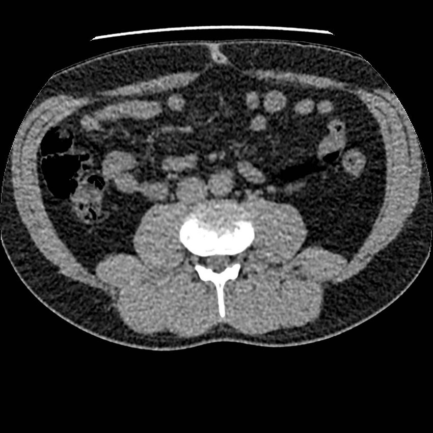 Obstructing ureteric calculus and ureteric anatomy (Radiopaedia 62730-71042 Axial non-contrast 71).jpg