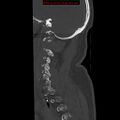Occipital condyle fracture (Radiopaedia 18366-18208 Sagittal bone window 5).jpg