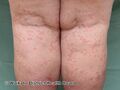 Urticaria (DermNet NZ systemic-w-itchy-skin-68).jpg