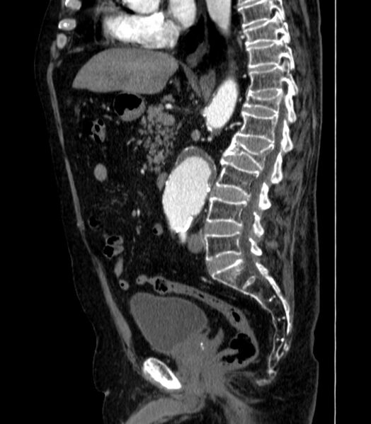 File:Abdominal aortic aneurysm (Radiopaedia 25855-26001 Sagittal C+ arterial phase 26).jpg