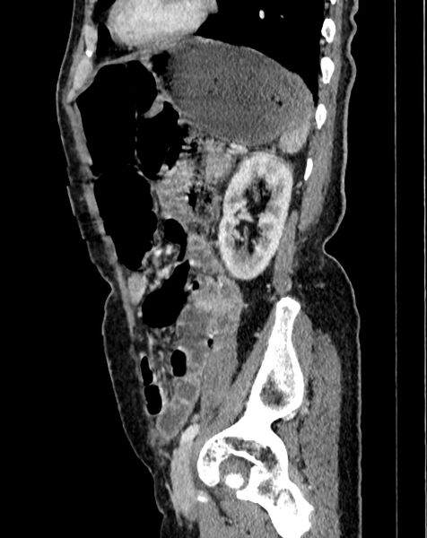 File:Abdominal aortic aneurysm (Radiopaedia 83581-98689 Sagittal C+ portal venous phase 99).jpg