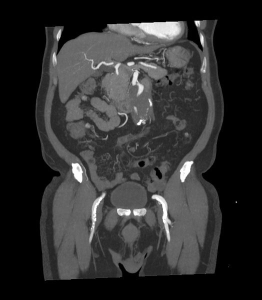 File:Abdominal aortic aneurysm with thrombus fissuration (Radiopaedia 46218-50618 Coronal C+ arterial phase 24).jpg