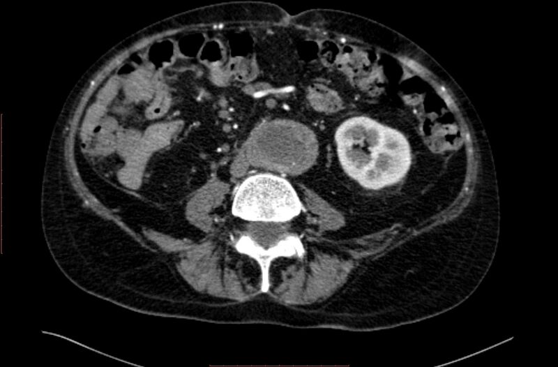 File:Abdominal aortic interposition tube graft and aneurysm thrombosis (Radiopaedia 71438-81857 Axial C+ arterial phase 103).jpg