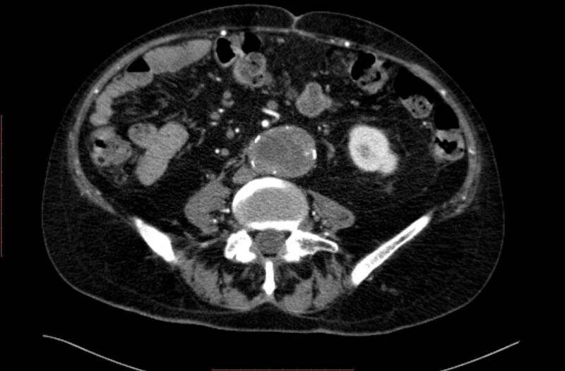 File:Abdominal aortic interposition tube graft and aneurysm thrombosis (Radiopaedia 71438-81857 Axial C+ arterial phase 113).jpg
