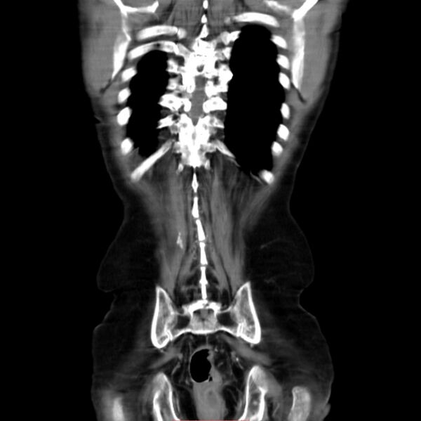 File:Abdominal aortic interposition tube graft and aneurysm thrombosis (Radiopaedia 71438-81857 Coronal C+ arterial phase 25).jpg