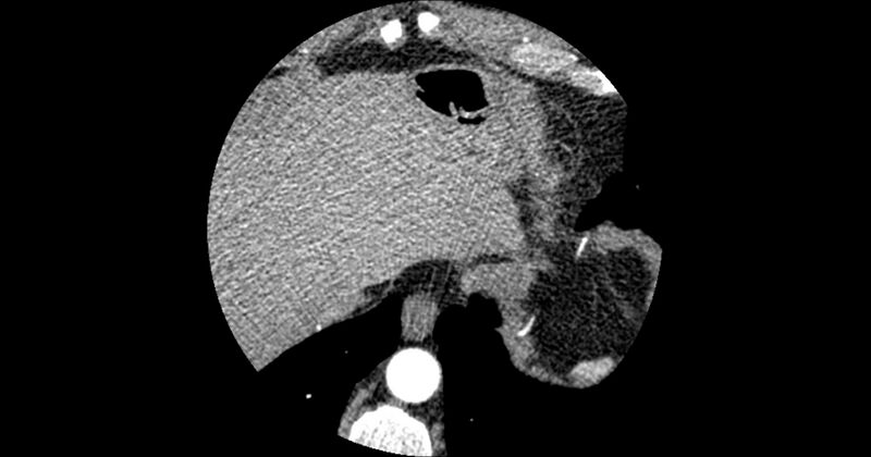 File:Aberrant left main coronary artery (ALMCA) arising from the right sinus with interarterial course (Radiopaedia 63251-71814 Axial C+ arterial phase 191).JPG