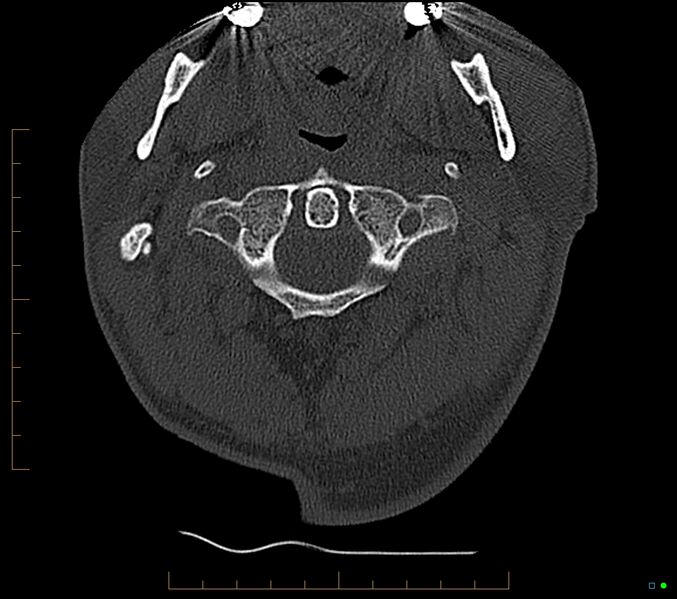 File:Accessory articulation of cervical transverse processes (Radiopaedia 82715-96933 Axial non-contrast 19).jpg