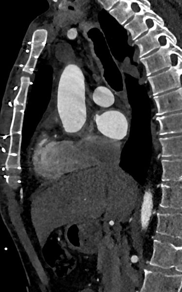 File:Accessory left atrial appendage (Radiopaedia 81987-95968 Sagittal C+ arterial phase 35).jpg