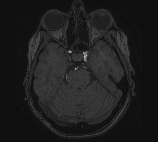 File:Accessory middle cerebral artery and ICA aneurysm (Radiopaedia 22656-22674 MRA 30).jpg