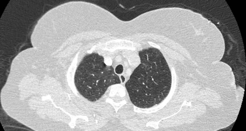 File:Accessory right inferior hepatic vein (Radiopaedia 65245-74259 Axial lung window 7).jpg