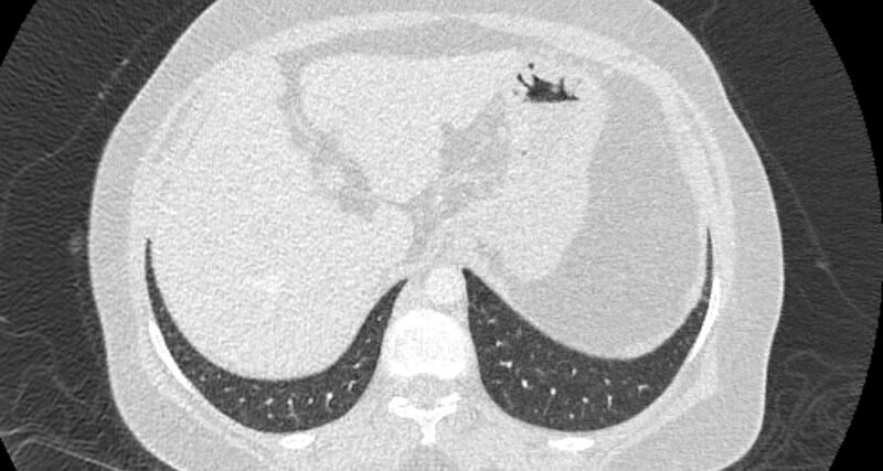 File:Accessory right inferior hepatic vein (Radiopaedia 65245-74259 Axial lung window 70).jpg