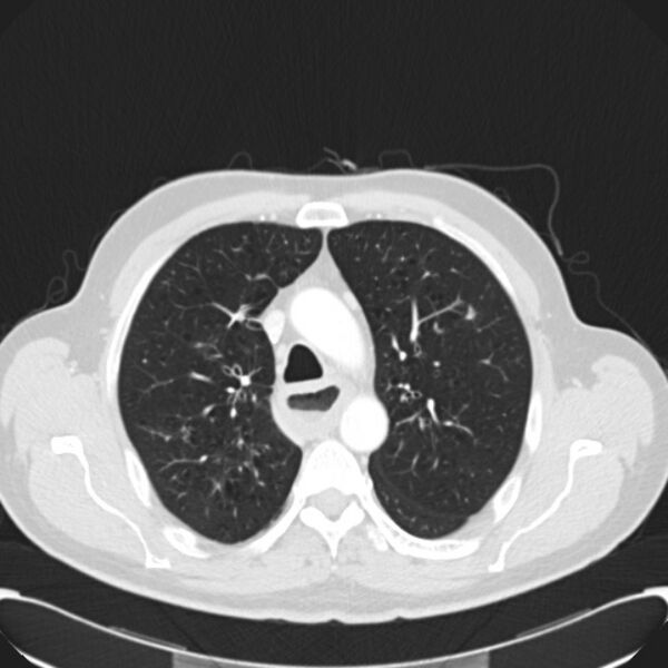 File:Achalasia (Radiopaedia 24937-25206 Axial lung window 10).jpg