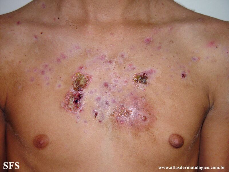 File:Acne Fulminans (Dermatology Atlas 4).jpg