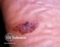 Acral lentignous melanoma (DermNet NZ lesions-melanoma-s-alm4).jpg