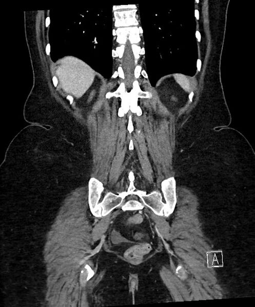 File:Active Crohn disease (Radiopaedia 59394-66750 Coronal C+ portal venous phase 56).jpg