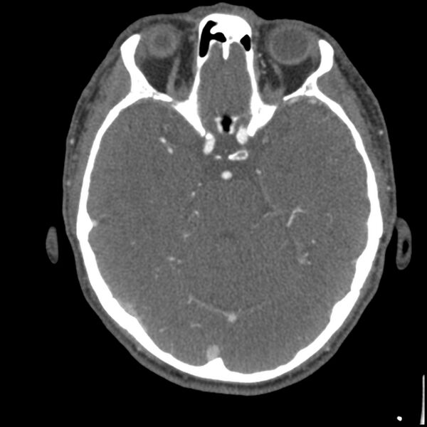 File:Acute P1 occlusion with PCA ischemia penumbra (CT perfusion) (Radiopaedia 72084-82587 Axial C+ arterial thins 54).jpg