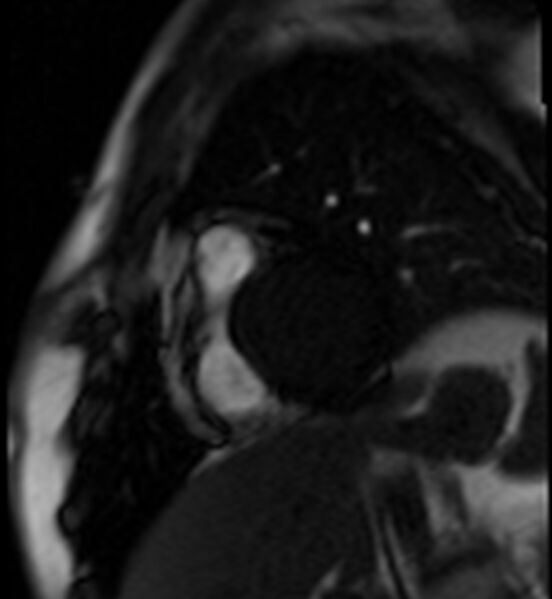 File:Acute anteroseptal myocardial infarction (Radiopaedia 68409-77945 Short axis (basal) Perfusion 6).jpg