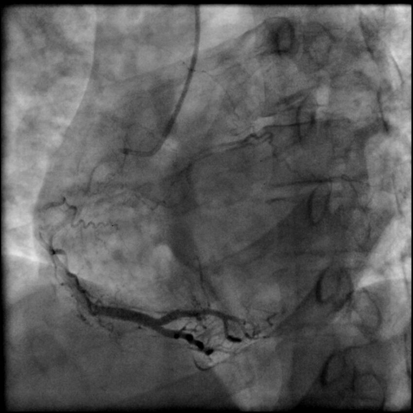 Acute anteroseptal myocardial infarction (Radiopaedia 68409-77946 RAO straight RCA 51).jpg