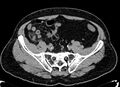 Acute appendicitis (Radiopaedia 13030-13091 Axial non-contrast 42).jpg