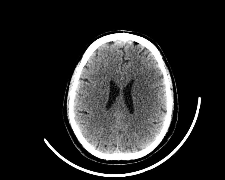 File:Acute cerebral infarct (Radiopaedia 35604-37123 Axial non-contrast 67).jpg
