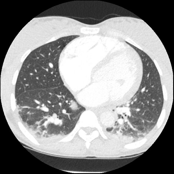 File:Acute chest syndrome - sickle cell disease (Radiopaedia 42375-45499 Axial lung window 120).jpg
