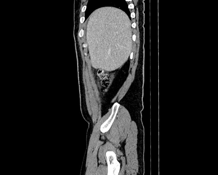File:Acute cholecystitis (Radiopaedia 53216-59182 Sagittal C+ portal venous phase 2).jpg