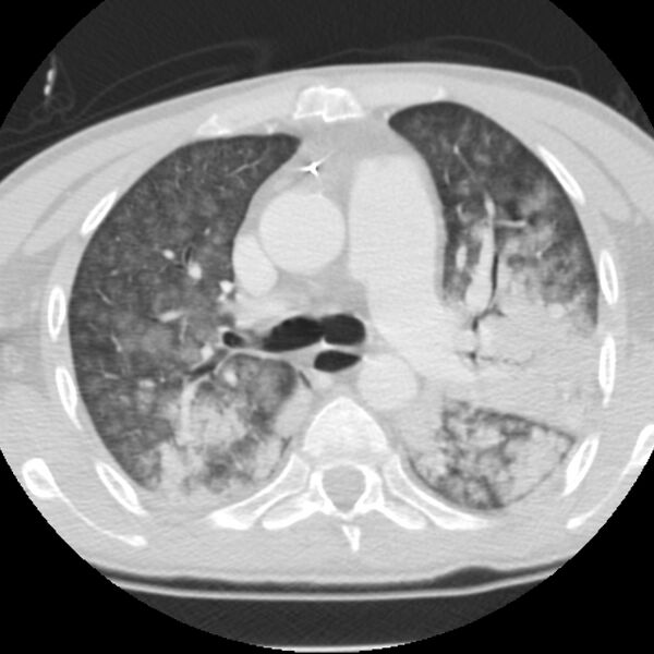 File:Acute diffuse alveolar hemorrhage (Radiopaedia 41323-44158 Axial lung window 21).jpg