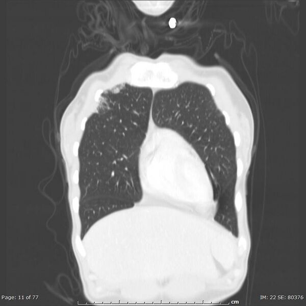 File:Acute eosinophilic pneumonia (Radiopaedia 48211-53073 Coronal 41).jpg