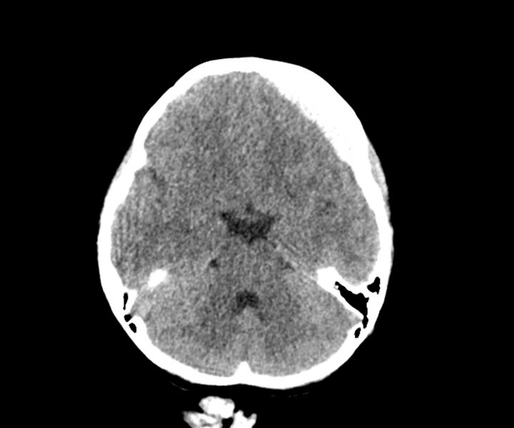 File:Acute epidural hematoma (Radiopaedia 63659-72335 Axial non-contrast 5).jpg