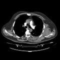Acute heart failure (CT) (Radiopaedia 79835-93075 Axial C+ arterial phase 2).jpg