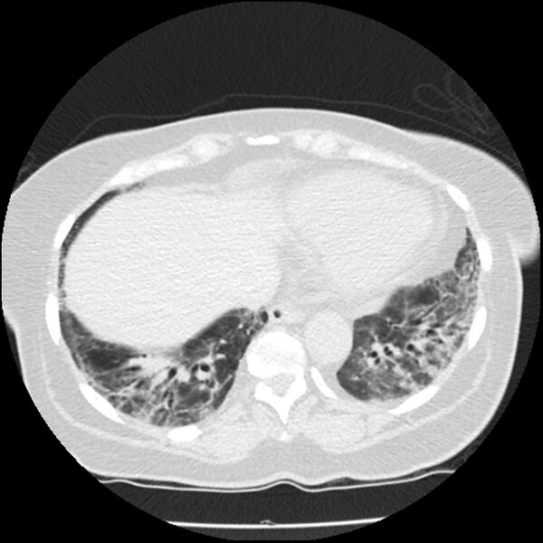 File:Acute interstitial pneumonitis (Radiopaedia 45404-49444 Axial lung window 78).jpg