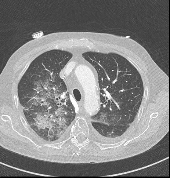 File:Acute myocardial infarction (Radiopaedia 23413-23481 lung window 8).jpg